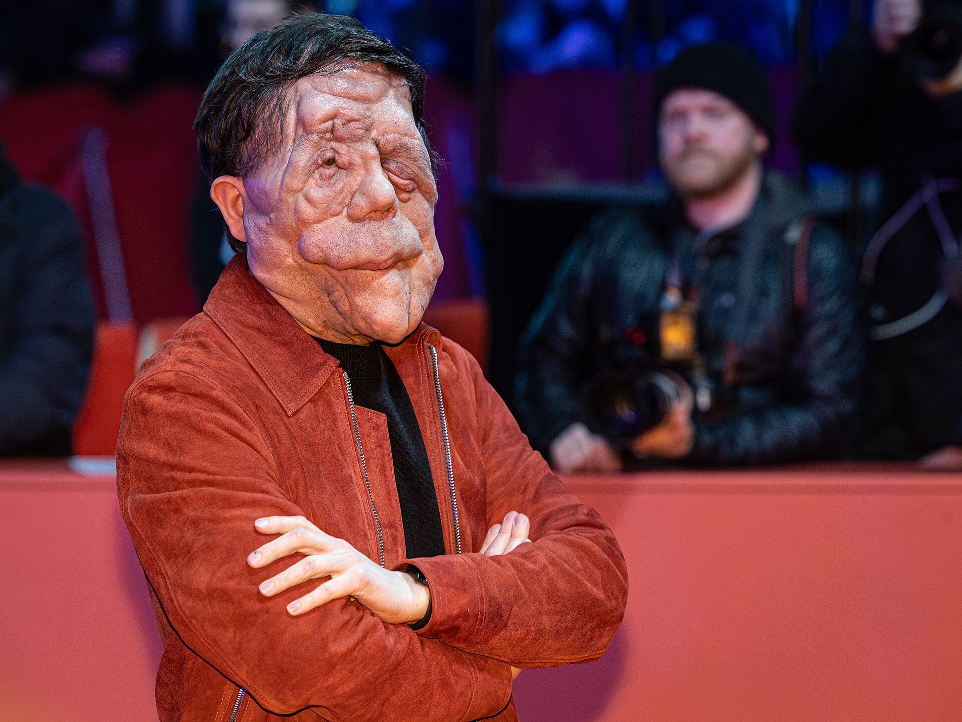 Neurofibromatose: A Complexidade Genética, o Desafio Social e a Luta por Acesso à Saúde