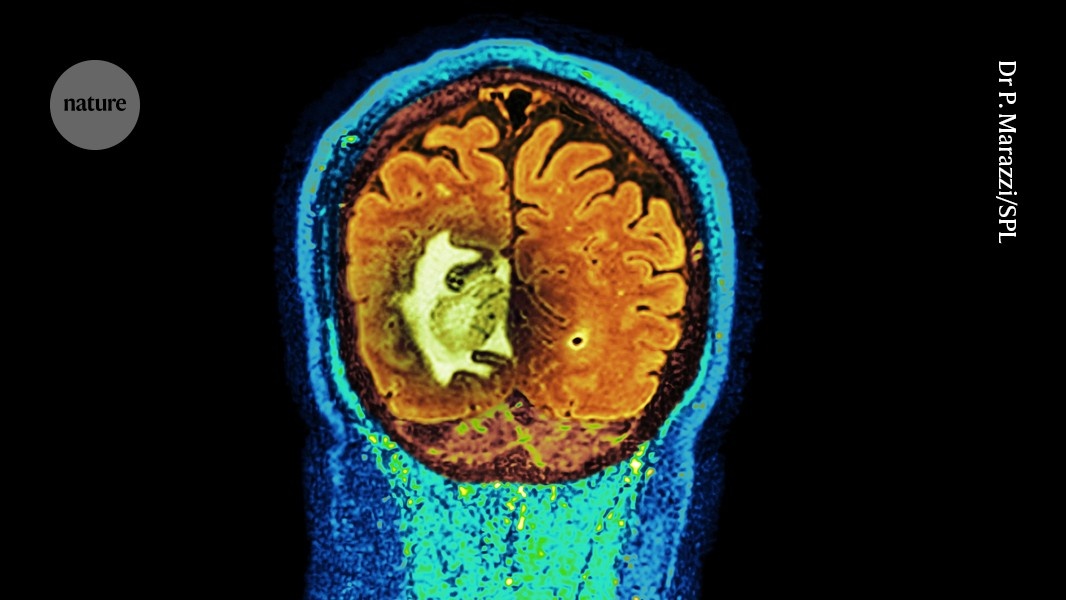 Revolução na Oncologia: Vacina de DNA Personalizada Oferece Nova Esperança Contra o Glioblastoma
