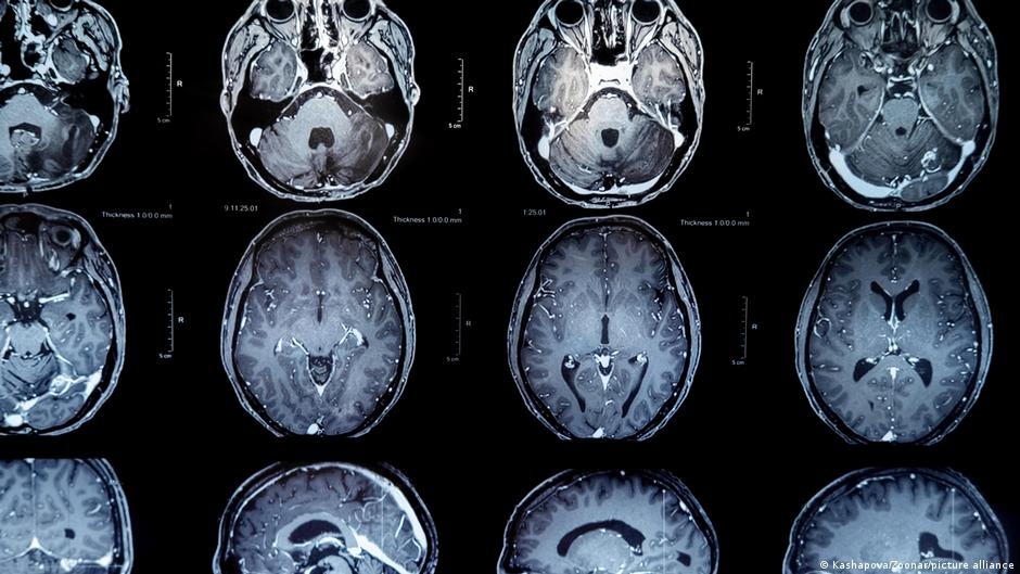 Vacina Experimental Contra Tumores Cerebrais Demonstra Potencial Inédito em Estudo de Longo Prazo