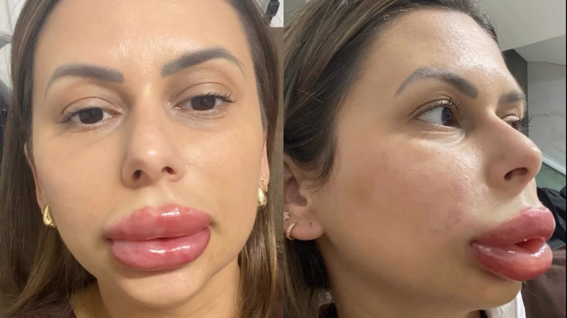 Preenchimento Labial Viral em SC: Mais Que Um Inchaço, Um Alerta Para O Mercado Estético Regional