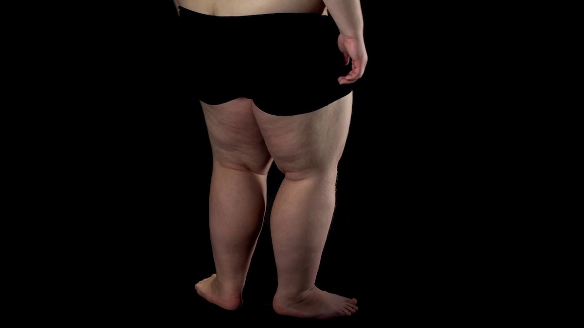Desvendando o Lipedema Masculino: O Diagnóstico Silencioso e Seus Impactos Profundos