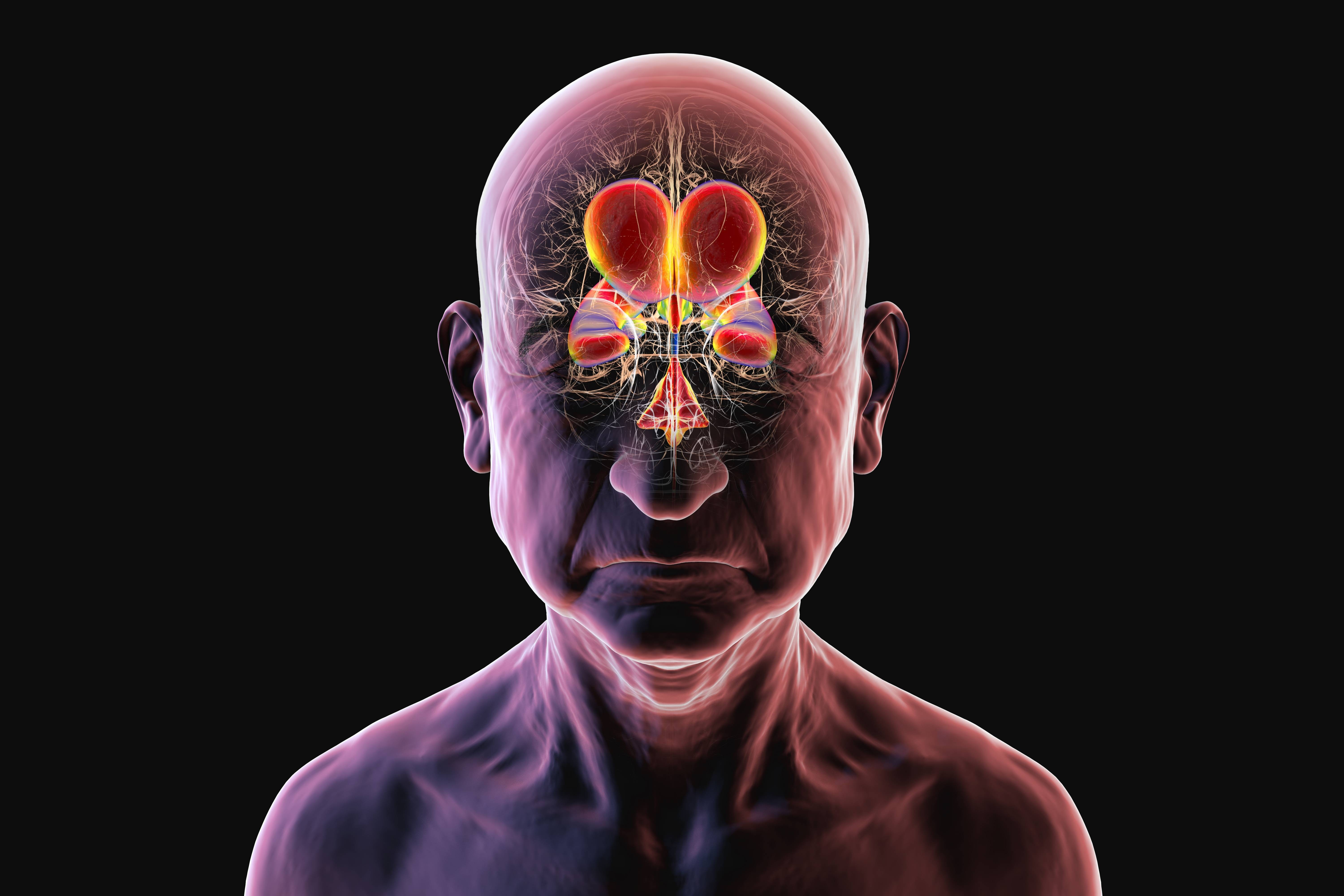 Hidrocefalia de Pressão Normal: A Esperança Reversível por Trás de Sintomas Semelhantes ao Alzheimer