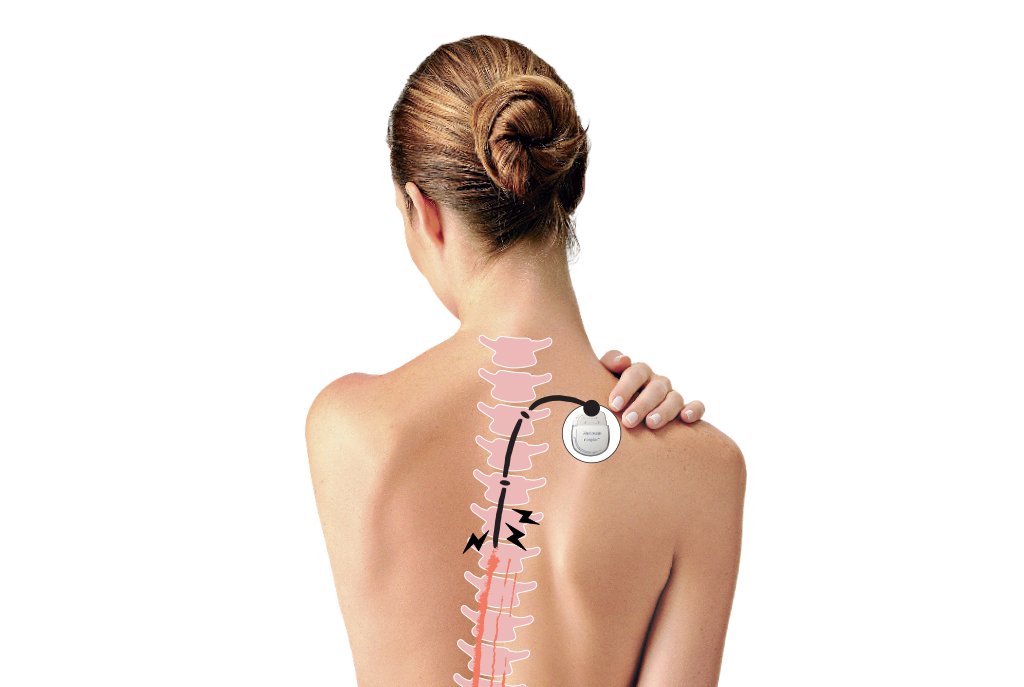 Implante modula dor nas costas em tempo real; saiba como funciona