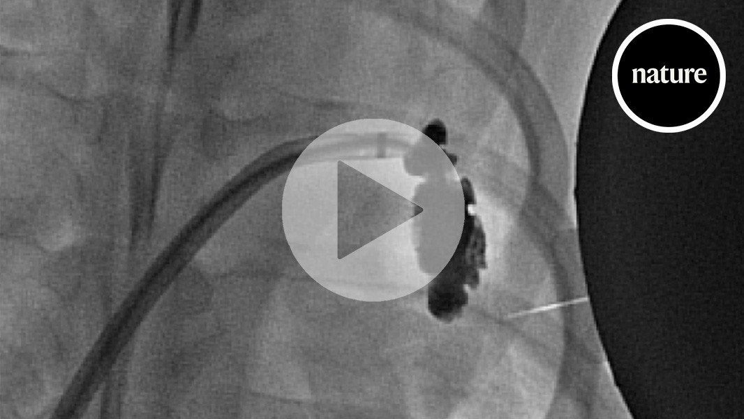 Gel magnético injetado no coração pode prevenir AVCs