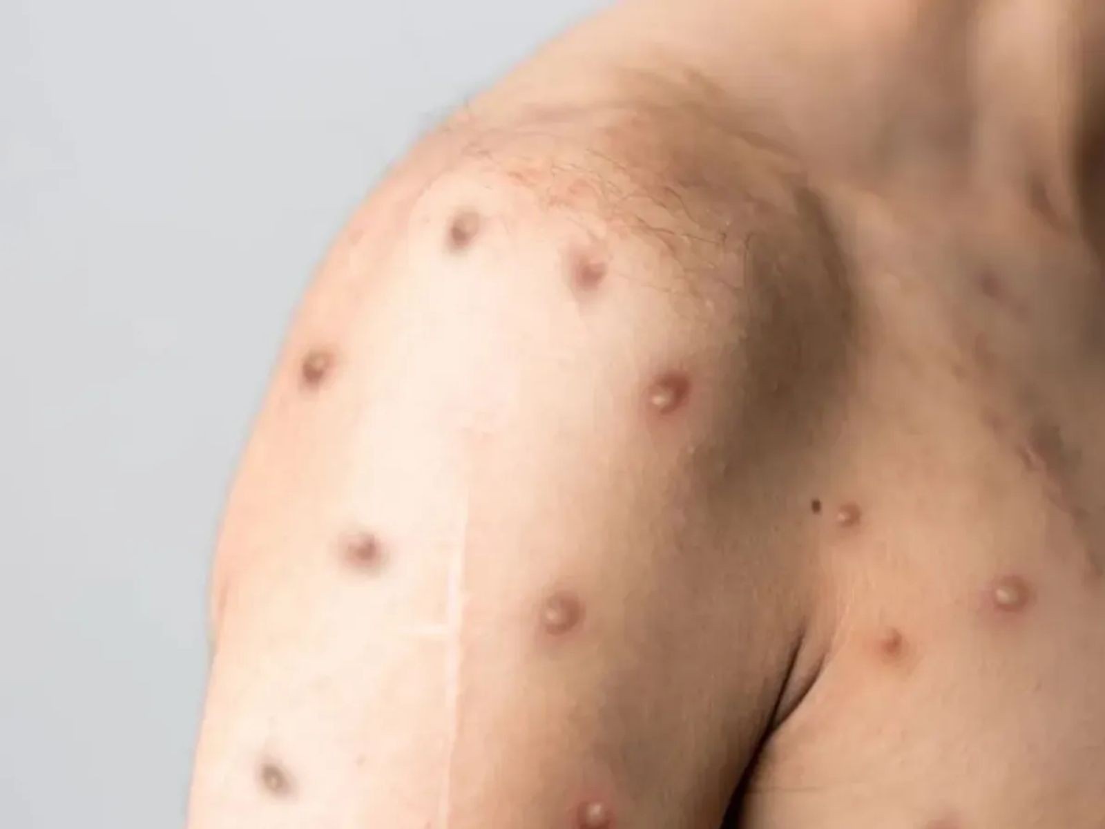 Mpox no Rio Grande do Norte: Análise da Reemergência e os Desafios para a Saúde Pública Regional