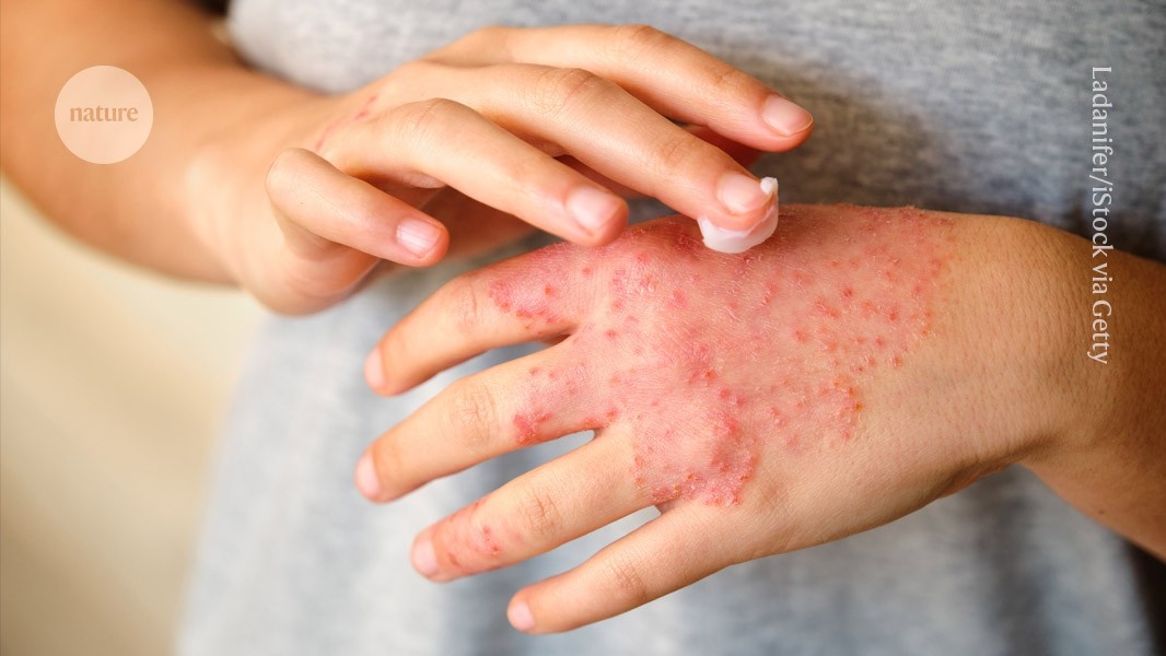 Desvendada Conexão Neural: Como o Estresse Desencadeia Crises de Eczema