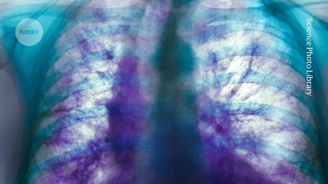 Desvendado Mecanismo Genético Crucial na Fibrose Pulmonar Idiopática: Nova Terapia em Horizonte